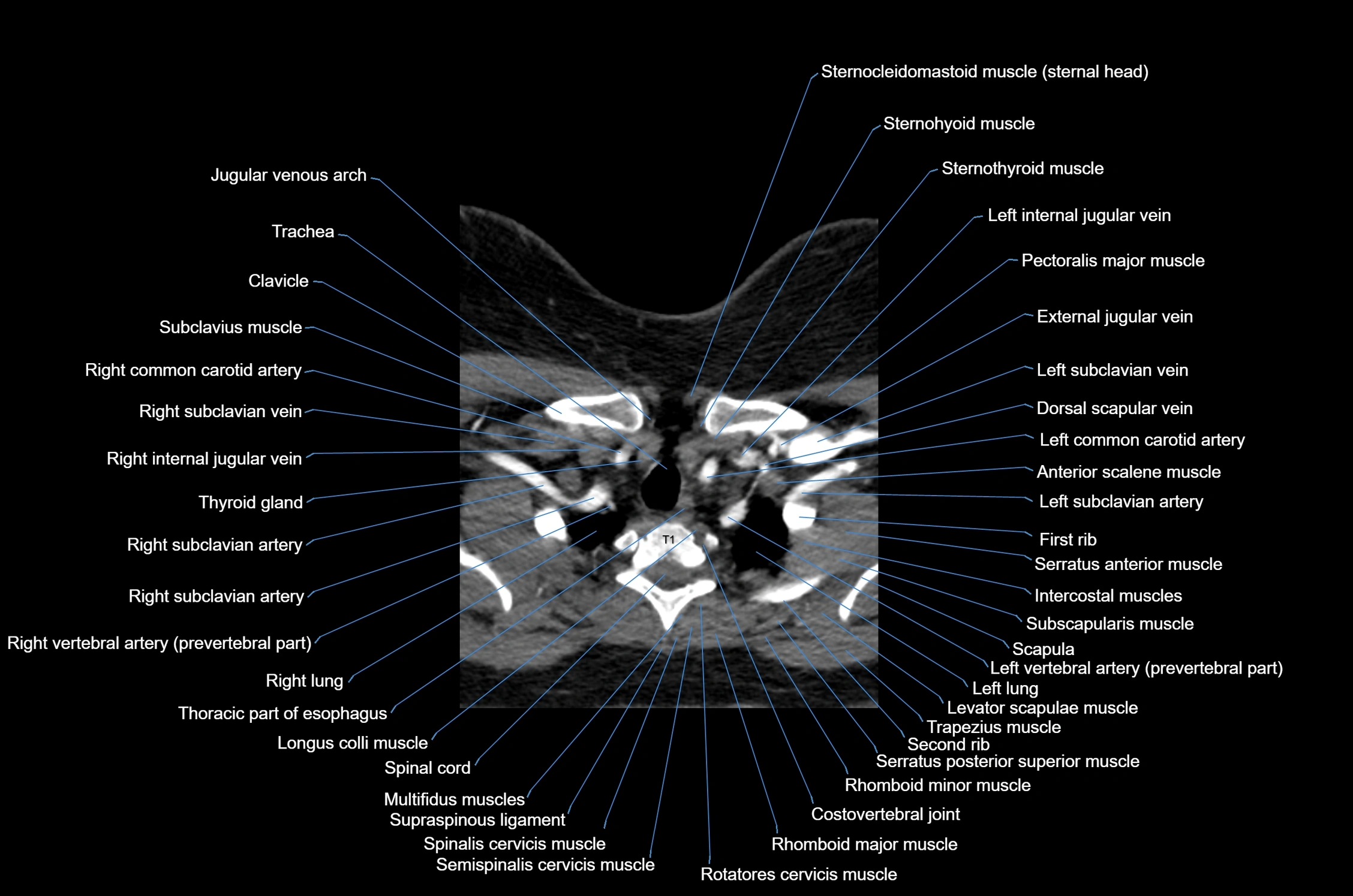 CT Neck axial cross sectional anatomy radiology image-img-00001-00055.webp